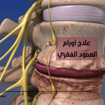 علاج أورام العمود الفقري