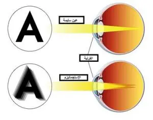 الاستجماتيزم