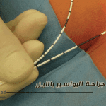 علاج البواسير بالليزر