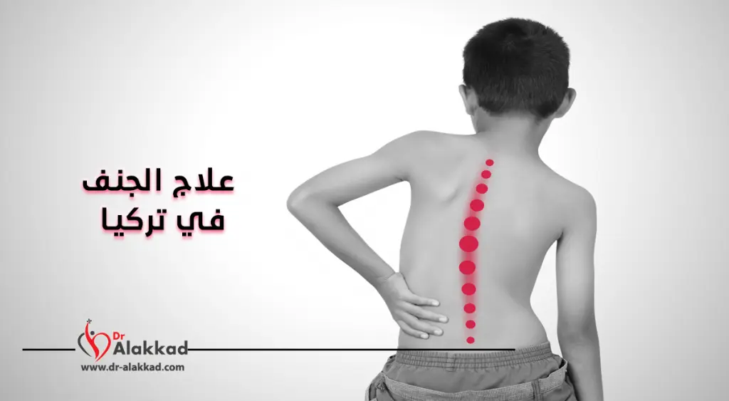 علاج الجنف في تركيا