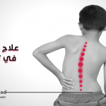 علاج الجنف في تركيا