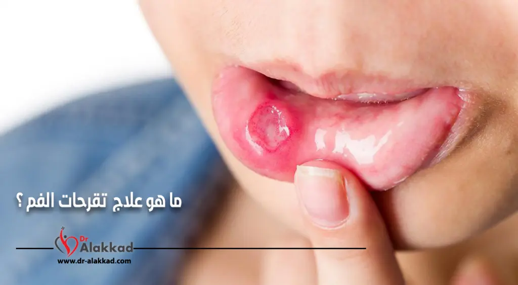 ما هو علاج تقرحات الفم ؟