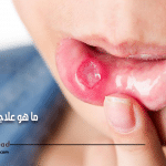 تقرحات الفم