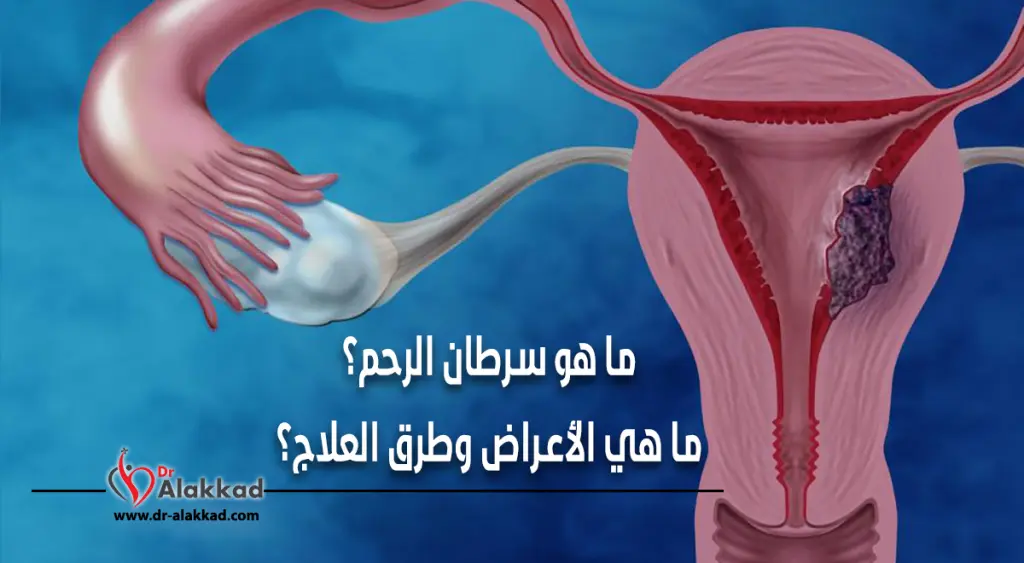 ما هو سرطان الرحم ؟ ما هي الأعراض وطرق العلاج ؟