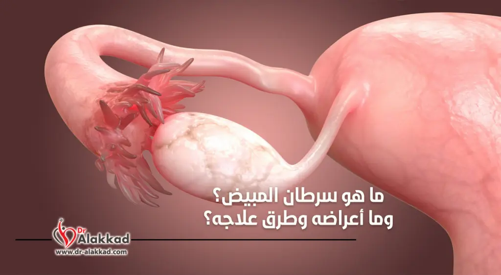 ما هو سرطان المبيض وما أعراضه وطرق علاجه؟