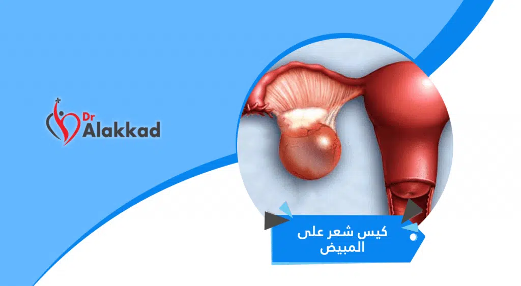 كيس شعر على المبيض الأعراض والتشخيص والعلاج