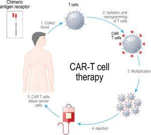 العلاج بالخلايا التائية CAR T-cell therapy 