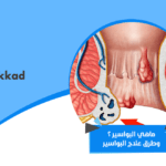 ماهي البواسير ؟ وطرق علاج البواسير !