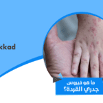 جدري القرود