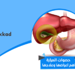 حصوات المرارة أهم أعراضها وعلاجها