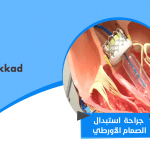 جراحة استبدال الصمام الأورطي