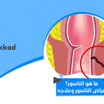 الناسور