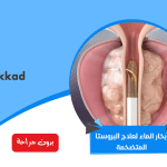 علاج تضخم البروستات ببخار الماء