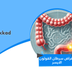 اعراض سرطان القولون الايسر