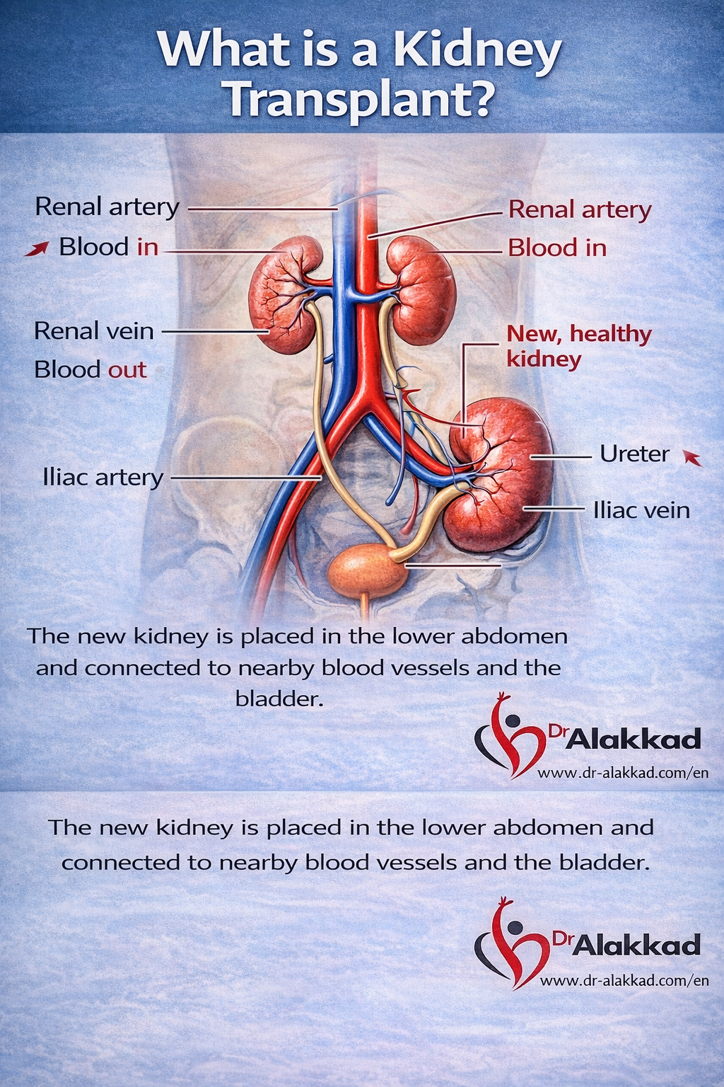 Kidney transplant in turkey